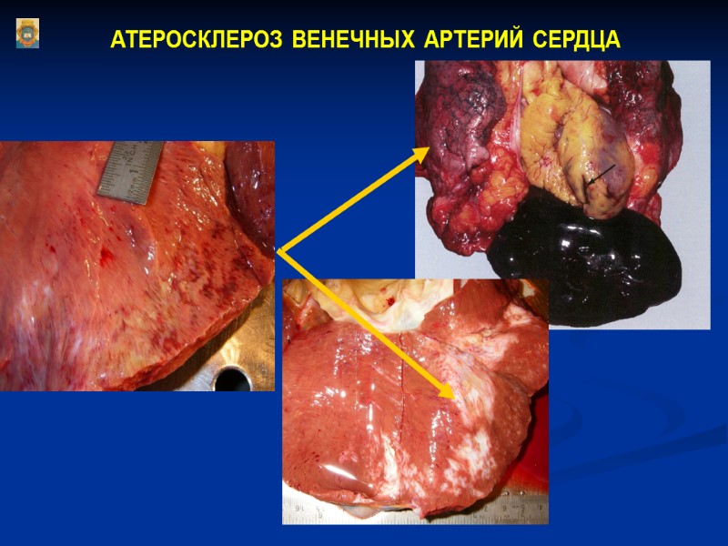 АТЕРОСКЛЕРОЗ ВЕНЕЧНЫХ АРТЕРИЙ СЕРДЦА